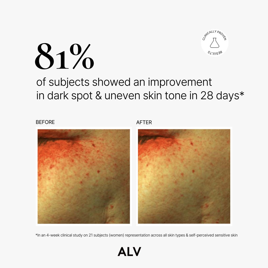 ALV 25% Advanced Vitamin C Derivative Brightening Serum – Radiance & Dark Spot Corrector (30ml / 1 fl.oz)