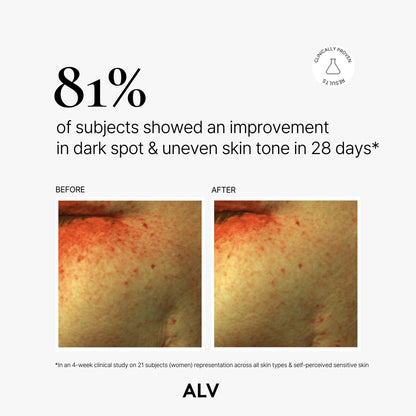 ALV 25% Advanced Vitamin C Derivative Brightening Serum – Radiance & Dark Spot Corrector (30ml / 1 fl.oz)