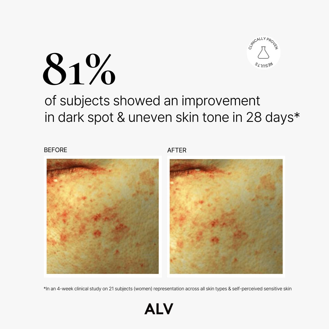 ALV 25% Advanced Vitamin C Derivative Brightening Serum – Radiance & Dark Spot Corrector (30ml / 1 fl.oz)